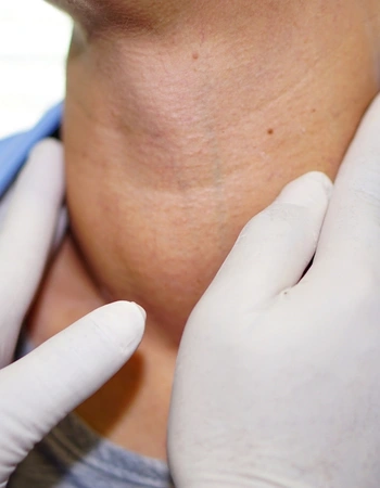 lipoma cervical Cirugía de Lipoma Cervical en Zapopan